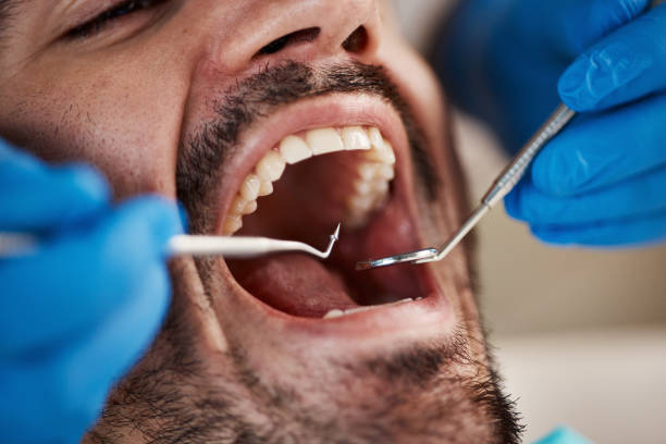 Best Emergency Wisdom Teeth Removal in Lone Star, TX